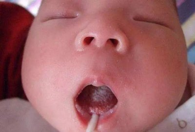 ​鹅口疮or奶垢傻傻分不清？金牌月嫂教你精准辨别，有3个小妙招