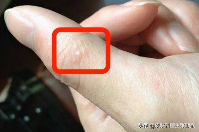 ​脚上手上起小水泡，小心是汗疱疹