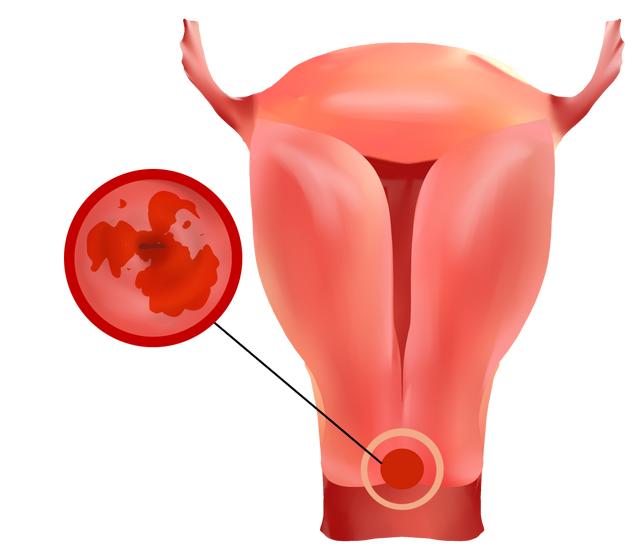 感染hpv以后身体出现的三个症状（感染HPV有哪些表现）(4)