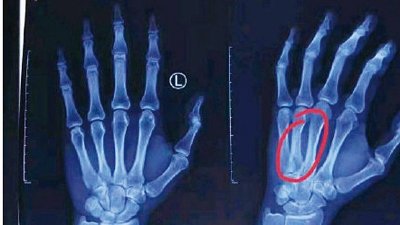 ​韩德君手掌骨折选择保守治疗，为避免二次伤害复出时间待定