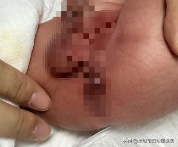 ​关爱出生缺陷，给宝宝无限未来——肛门闭锁患儿的“闯关大作战”